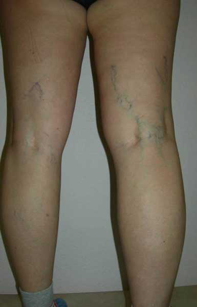varicose piele varicoză pe picioare la femei cauzează